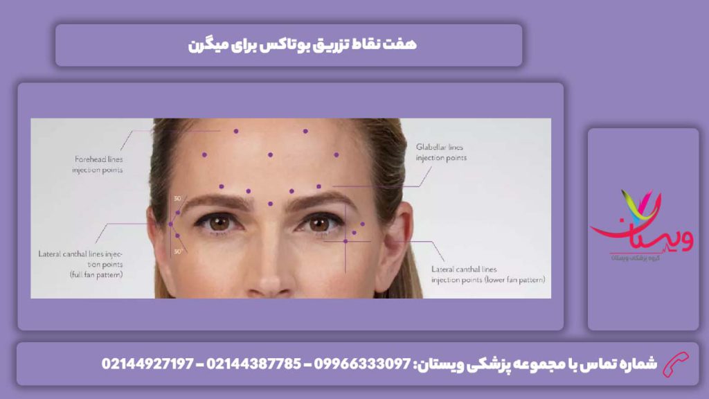 نقاط تزریق بوتاکس برای این مریضی درمان میگرن با بوتاکس