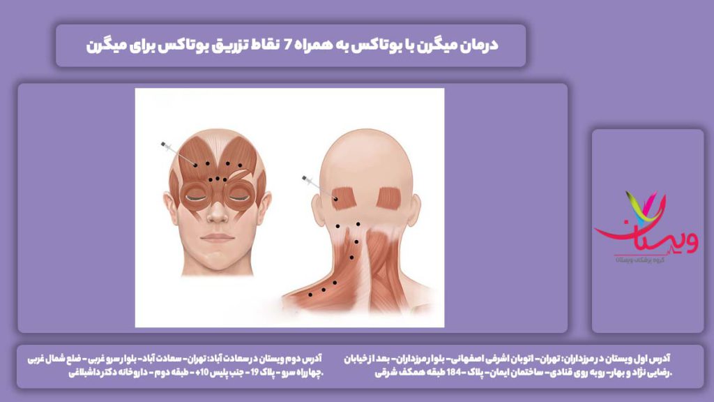 درمان میگرن با بوتاکس