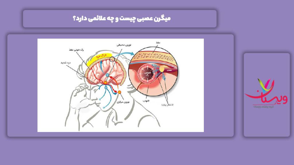 نشانههای میگرن عصبی میگرن عصبی چیست و چه علائمی دارد؟