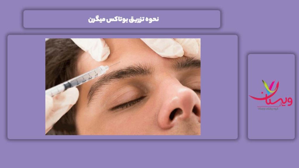نحوه تزریق بوتاکس برای میگرن نحوه تزریق بوتاکس میگرن