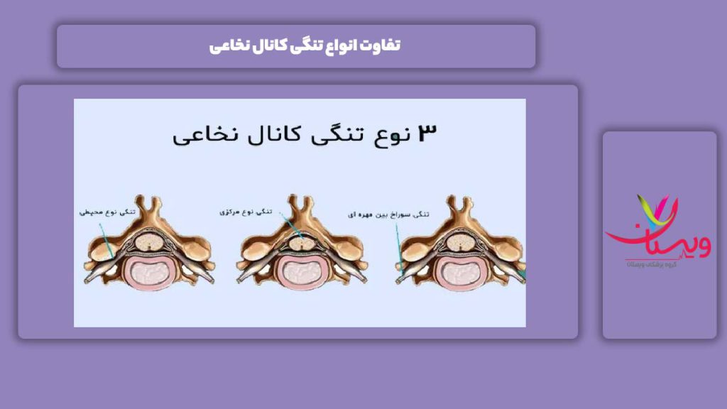 فرقهای انواع این مریضی تفاوت انواع تنگی کانال نخاعی