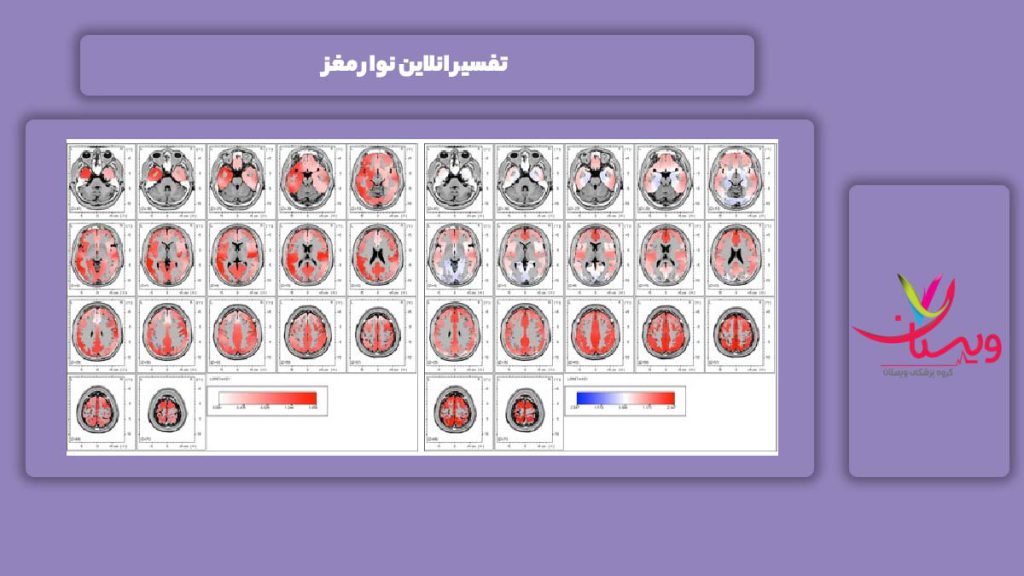 تفسیر این آزمایش به صورت آنلاین تفسیر انلاین نوار مغز