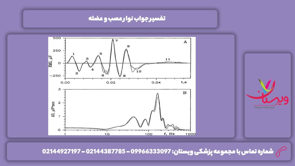 شرح جواب نوار عصب و عضله تفسیر جواب نوار عصب و عضله