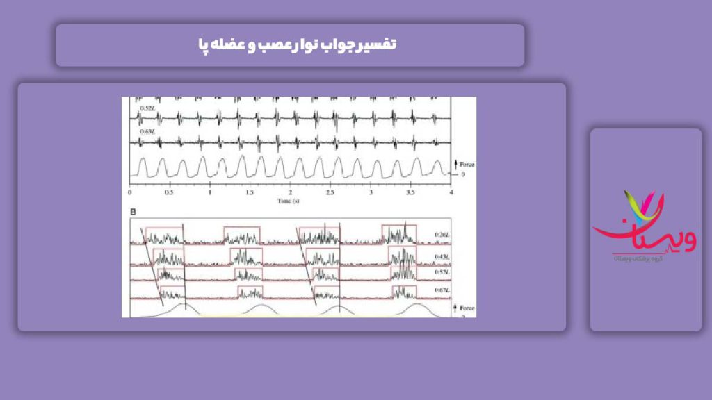 شرح جواب این آزمایش تفسیر جواب نوار عصب و عضله پا