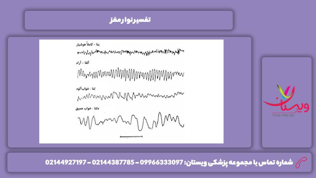 شرح نوار مغز تفسیر نوار مغز