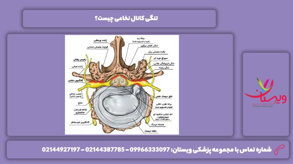 چیستی تنگی کانال نخاعی تنگی کانال نخاعی