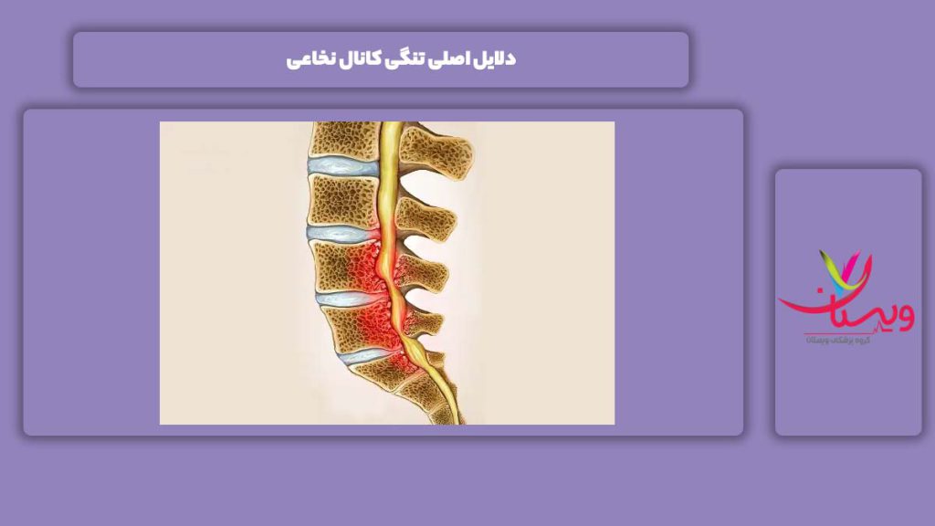 علت تنگی کانال نخاعی دلایل اصلی تنگی کانال نخاعی