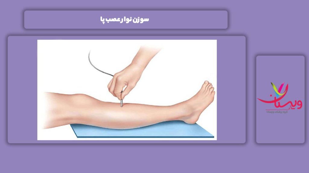 سوزن این نوار سوزن نوار عصب پا