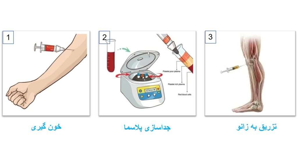  مراحل انجام پی آر پی زانو شامل خون گیری، جداسازی پلاسما و تزریق به زانو.