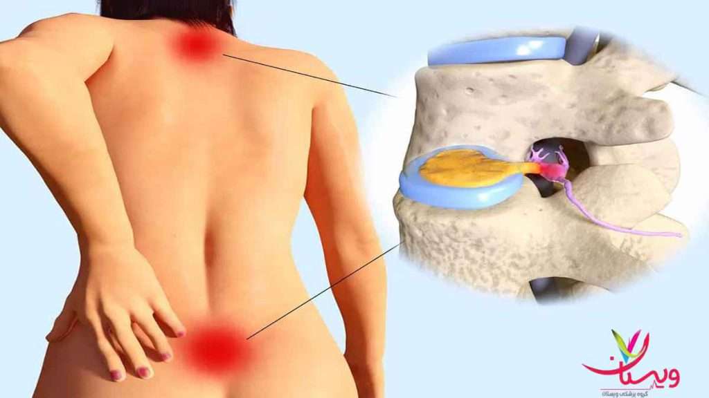کمر درد هزینه درمان دیسک کمر