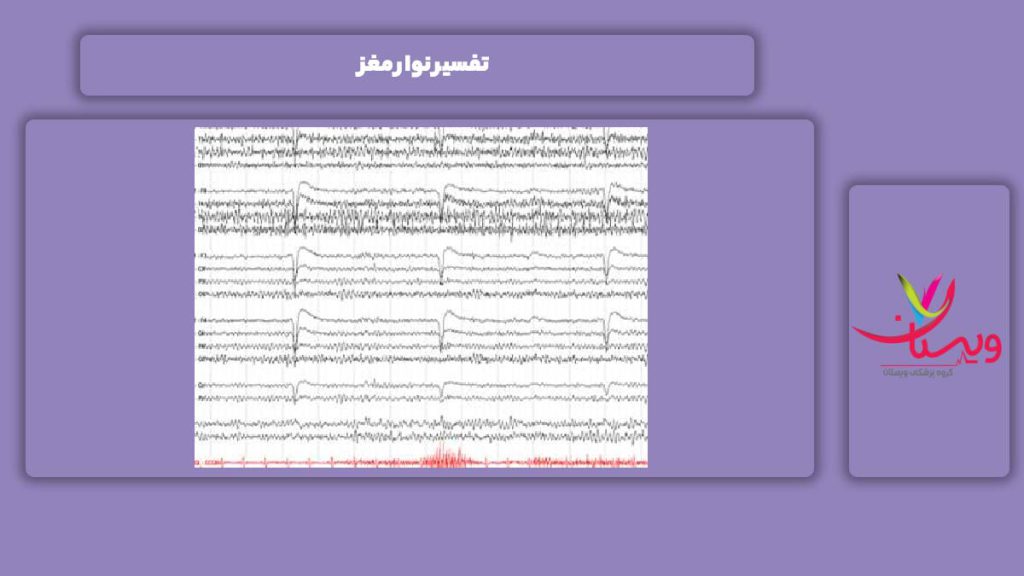 شرح کامل نوار مغز تفسیر نوار مغز