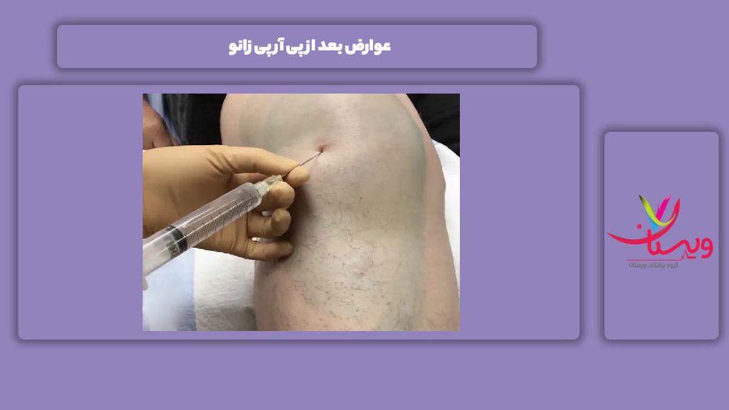 معایب بعد از پی آر پی زانو عوارض بعد از پی آر پی زانو