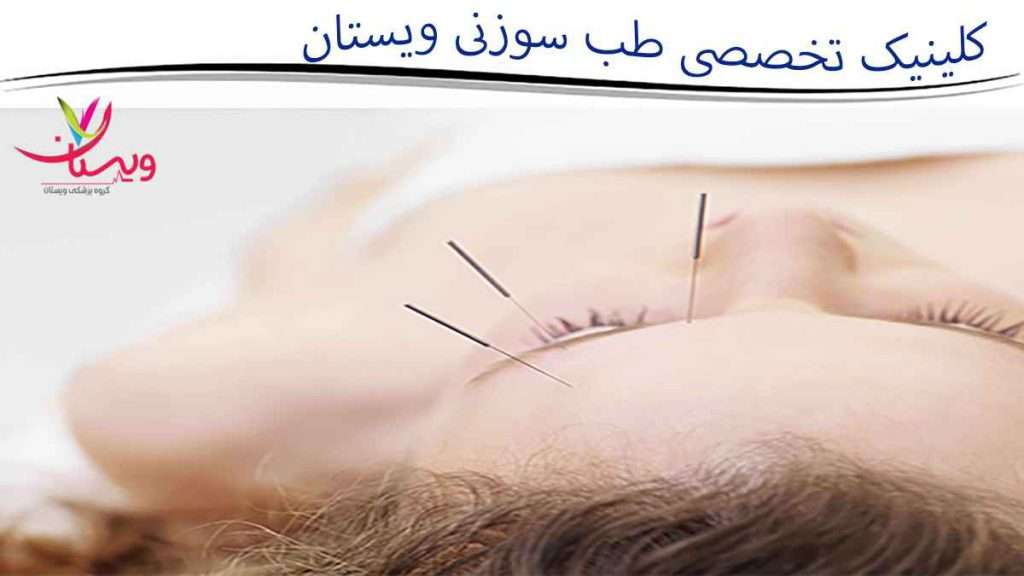 طب سوزنی درمان میگرن با طب سوزنی
