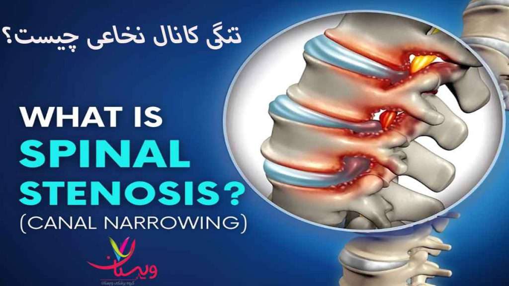تنگی کانال نخاع تنگی کانال نخاعی گردن