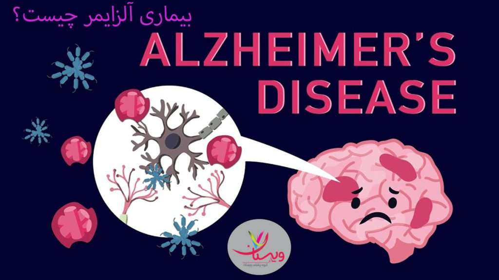 تعریف بیماری آلزایمر و از بین رفتن سلول های مغزی