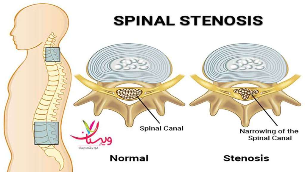 درباره تنگی کانال نخاع