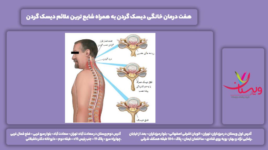 درمان خانگی دیسک گردن