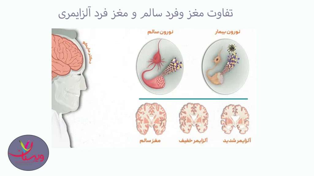تشخیص مغز فرد سالم از مغز فرد دارای آلزایمر