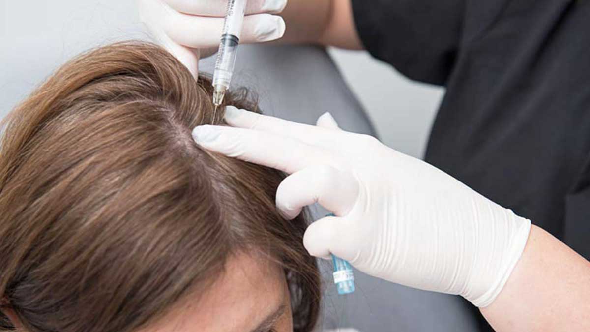 هزینه prp مو در بارداری هزینه پی آر پی مو