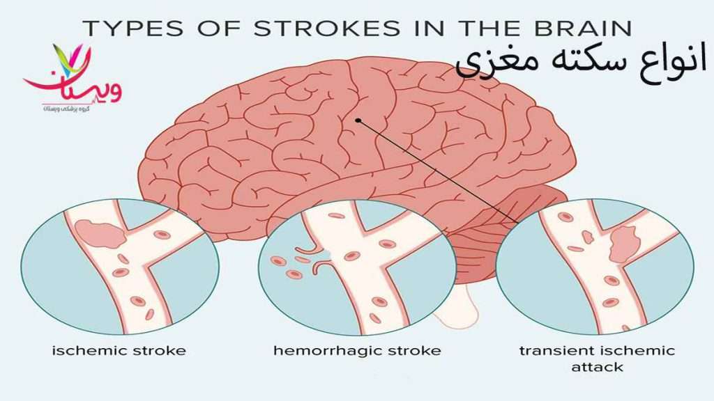 انواع سکته مغزی انواع سکته مغزی