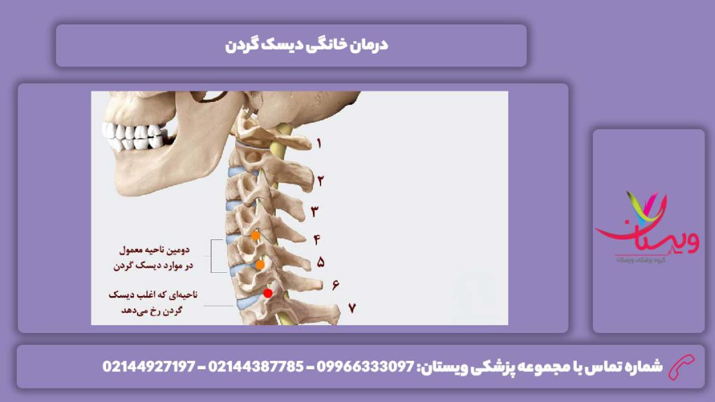 معالجه دیسک گردن در منزل درمان خانگی دیسک گردن