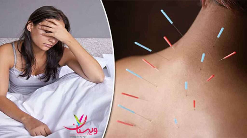 طب سوزنی برای سردرد مزایای طب سوزنی