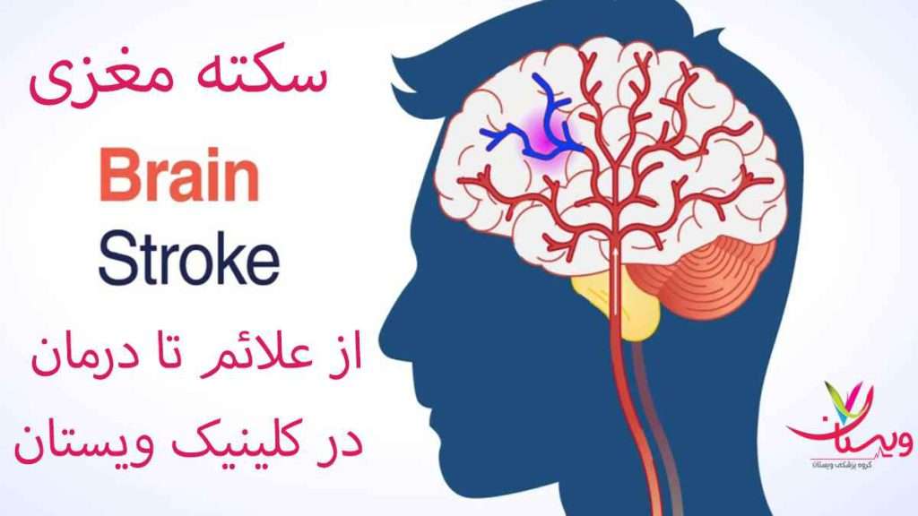 سکته مغزی