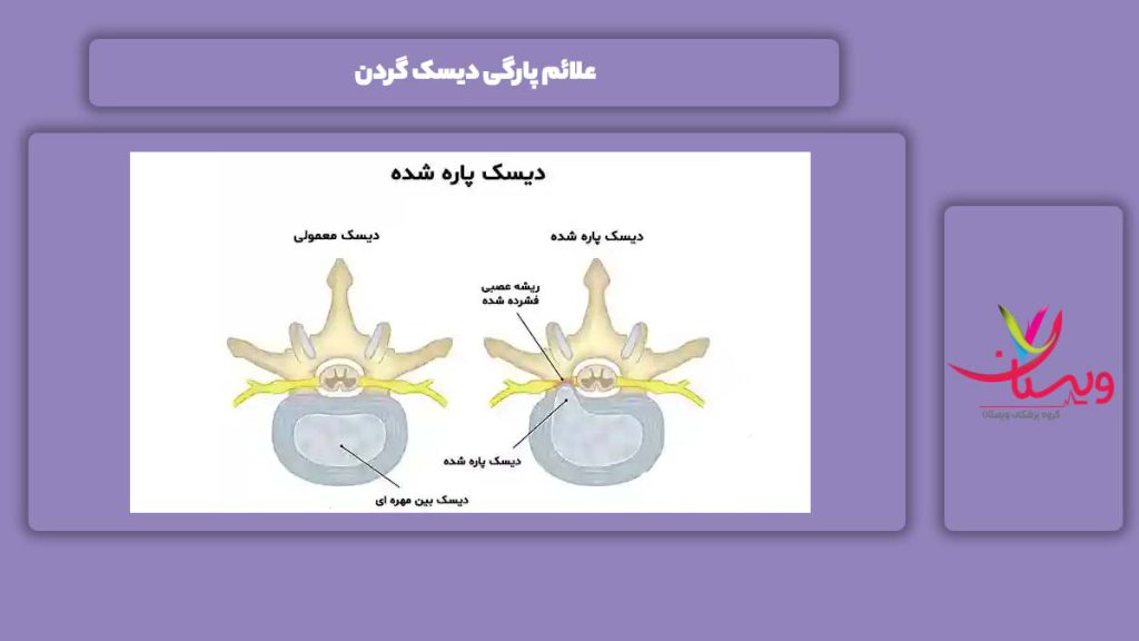 علامت پاره شدن دیسک گردن علائم پارگی دیسک گردن