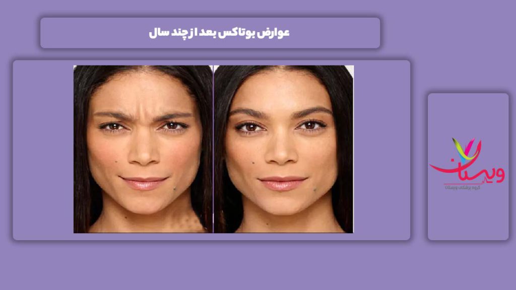 عوارض انجام بوتاکس طی سالهای متعدد عوارض بوتاکس بعد از چند سال
