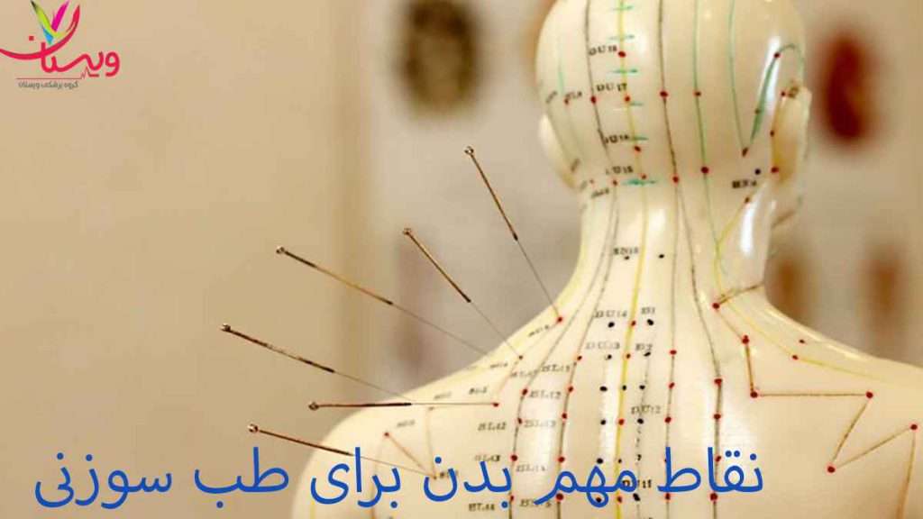 نقاط طب سوزنی
