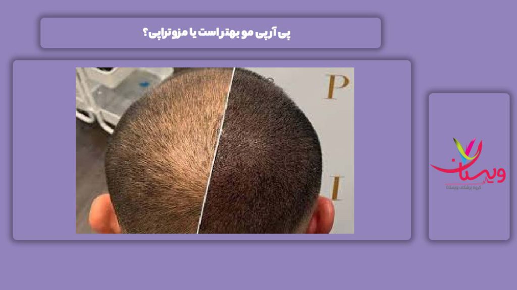 فرق پی آر پی و مزوتراپی برای مو پی آر پی مو بهتر است یا مزوتراپی؟