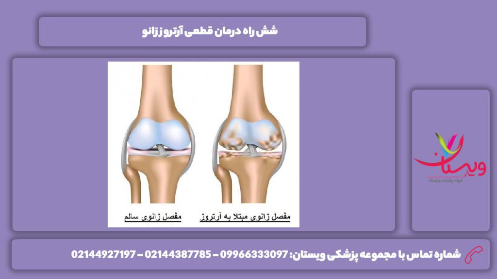 راههای درمان آرتروز زانو به صورت کامل درمان قطعی آرتروز زانو