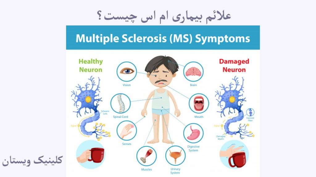 علائم یماری ms فرد دارای علائم ام اس