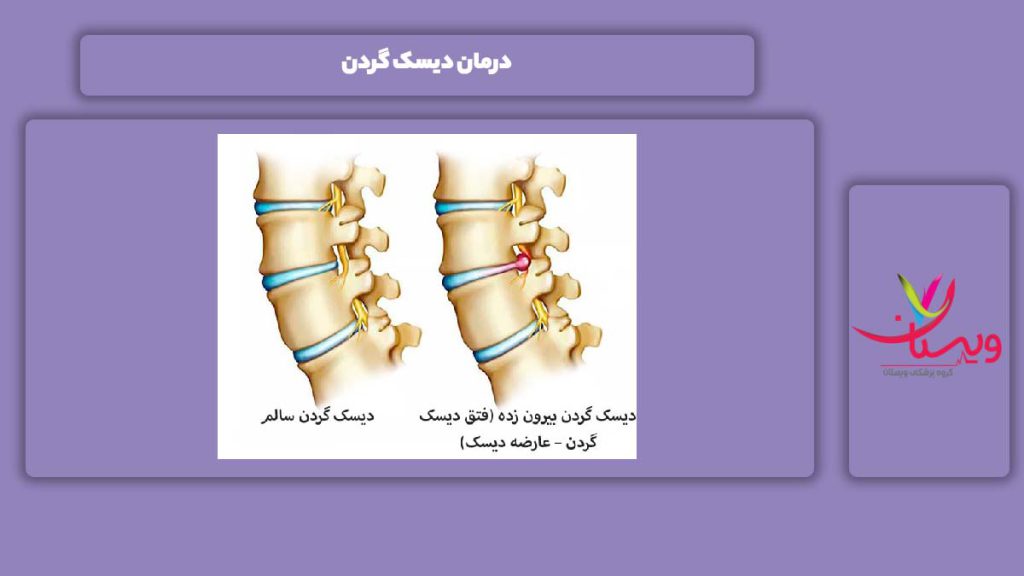 درمان این بیماری درمان دیسک گردن