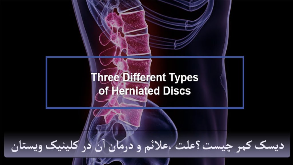 دیسک کمر ستون فقرات و دیسک کمر نمایش داده می شود