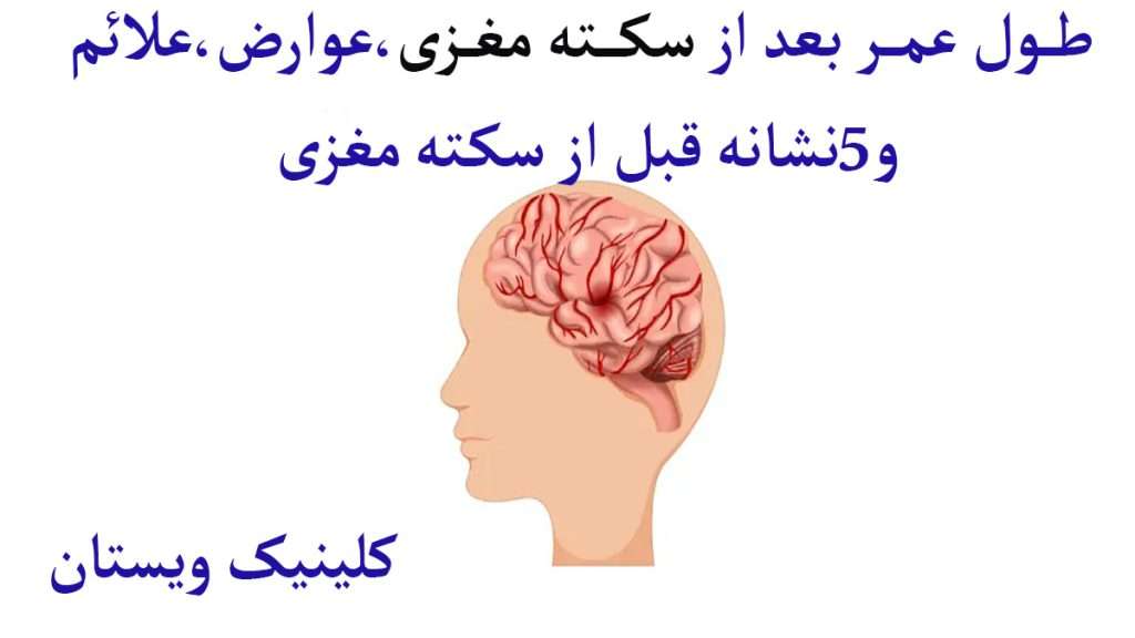 سکته مغزی چگونه است