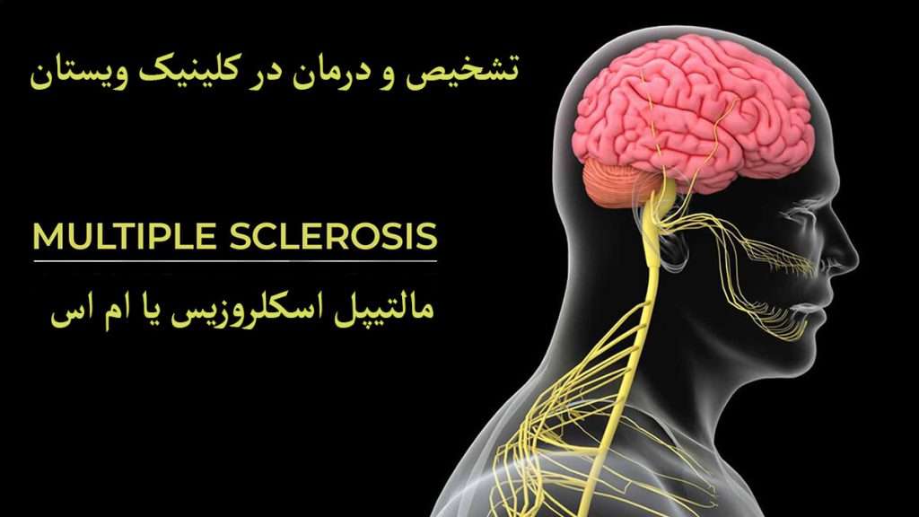 مغز فرد دارای بیماری ام اس