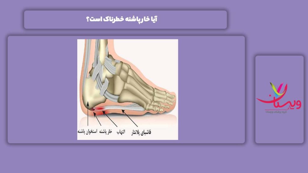 هولناک بودن این مریضی آیا خار پاشنه خطرناک است؟