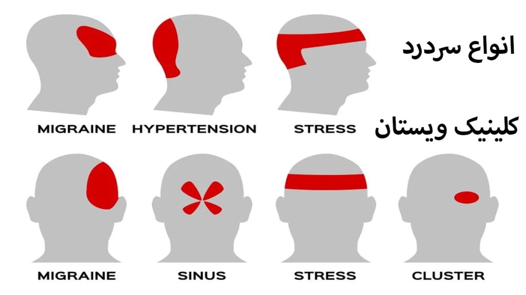 انواع سردرد برر روی سر یک شخص با رنگ قرمز نشان داده می شود