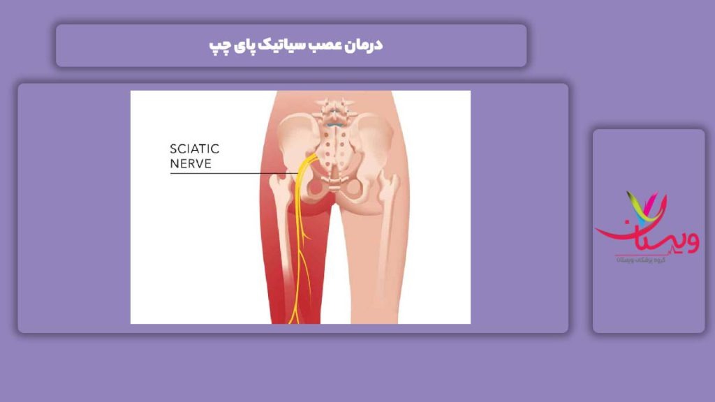 راه خوب شدن عصب سیاتیک پای چپ درمان عصب سیاتیک پای چپ