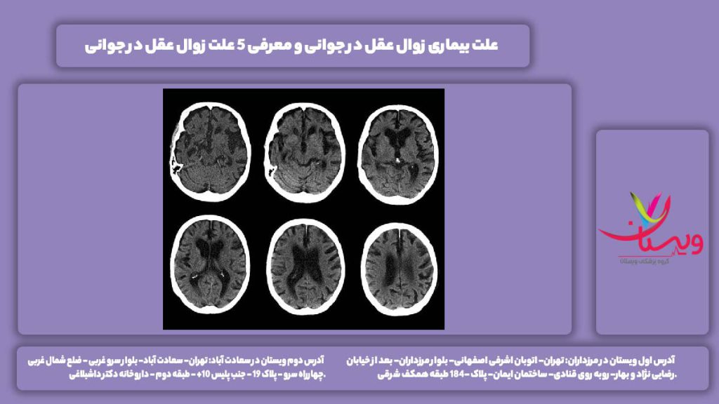 بیماری زوال عقل