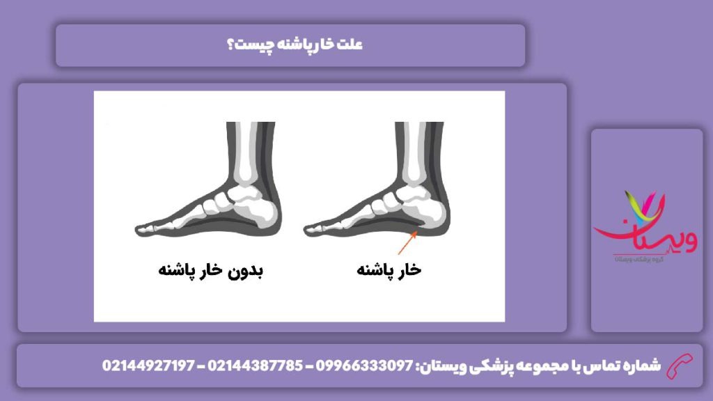 دلیل خارپاشنه درمان خار پاشنه