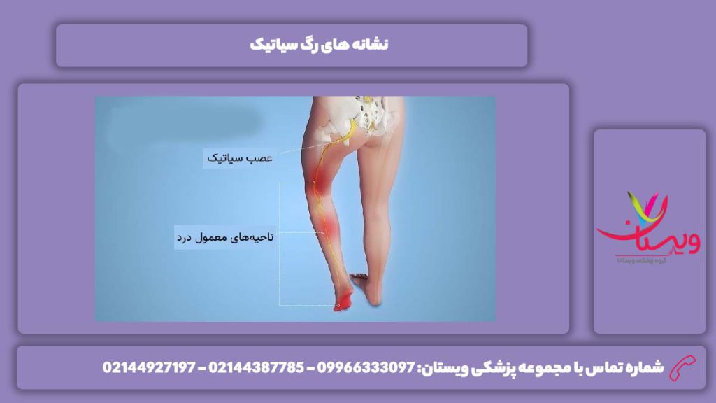 نشانه رگ سیاتیک سیاتیک