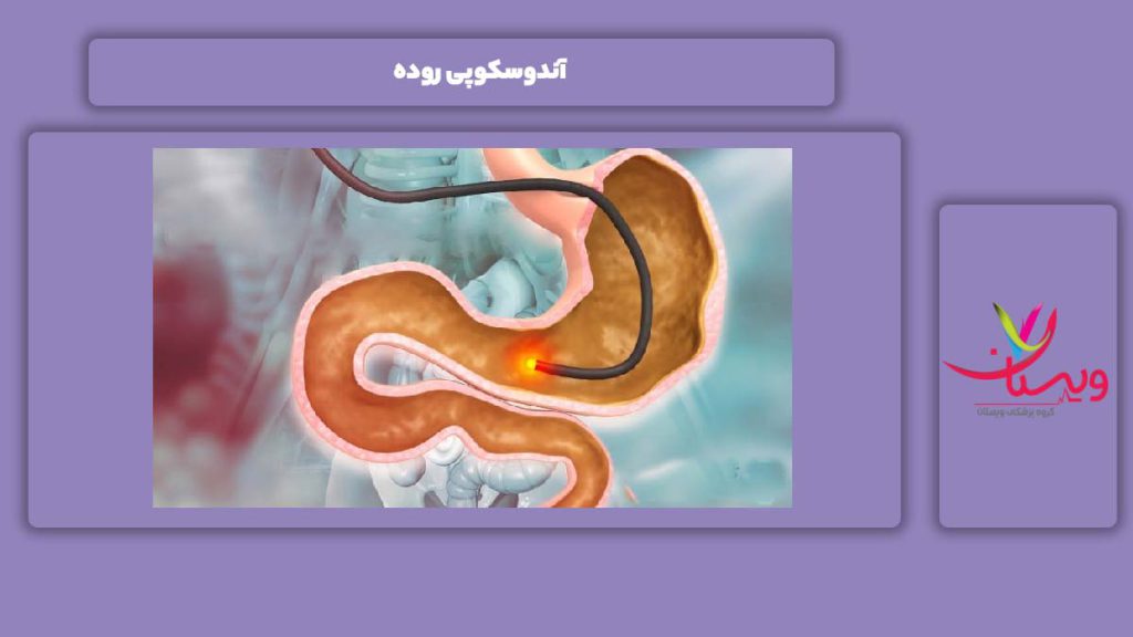 فواید آندوسکوپی برای روده آندوسکوپی روده