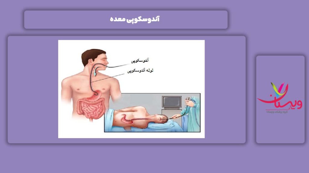 انجام آندوسکوپی برای معده آندوسکوپی معده