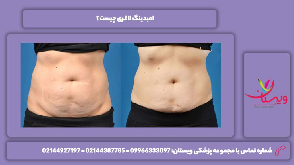 چیستی امبدینگ لاغری امبدینگ لاغری