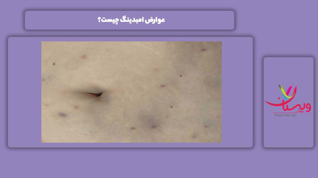ضررهای انجام امبدینگ عوارض امبدینگ چیست؟