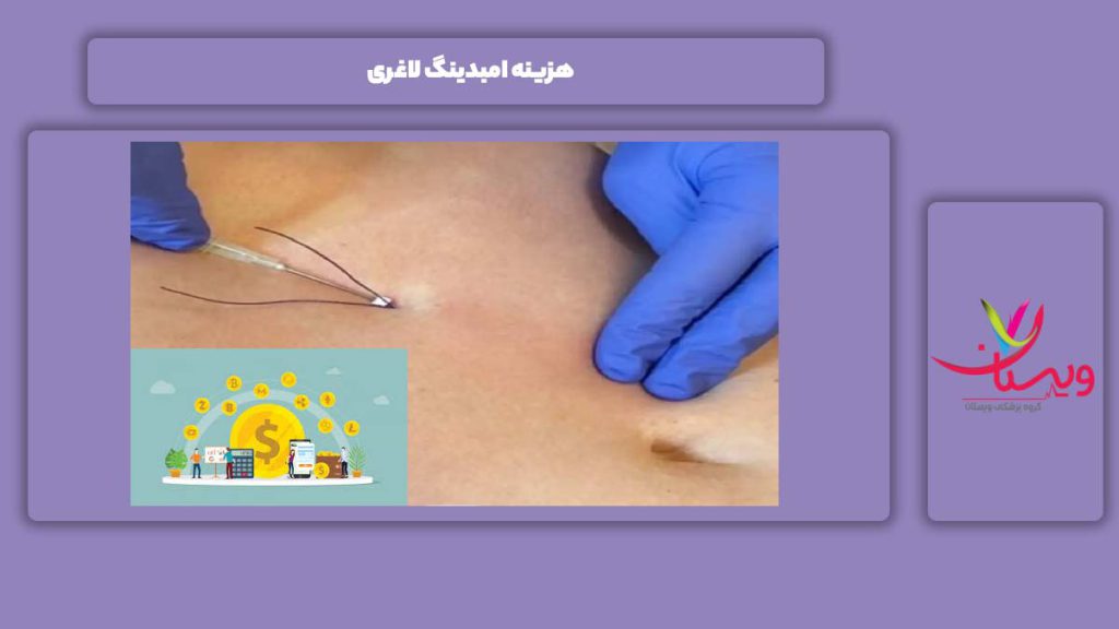 تعرفه انجام امبدینگ هزینه امبدینگ لاغری