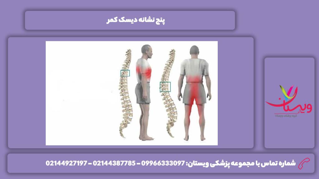 نشانههای دیسک کمر نشانههای دیسک کمر