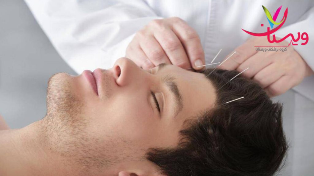 طب سوزنی در کلینیک ویستان متخصص طب سوزنی در کلینیک ویستان در حال انجام طب سوزنی برای سر بیمار
